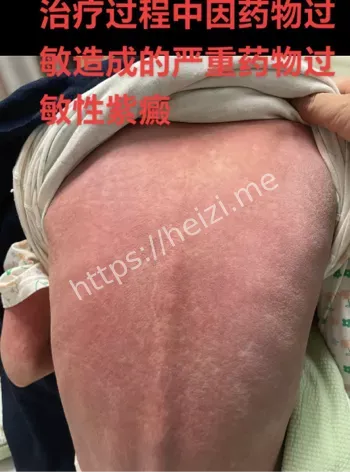 头骨碎裂