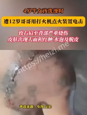 广西浦北女童洗澡受伤