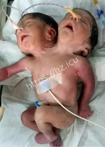 双头连体姐妹艾比成婚